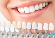 Albirea dentară – intervenţie apreciată de tot mai mulţi români